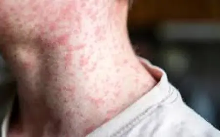 ਅਲਬਰਟਾ ਵਿੱਚ ਖਸਰੇ ਦੇ 53 ਹੋਰ ਮਾਮਲੇ ਦਰਜ, ਕੁੱਲ ਗਿਣਤੀ 900 ਤੱਕ ਪੁੱਜੀ