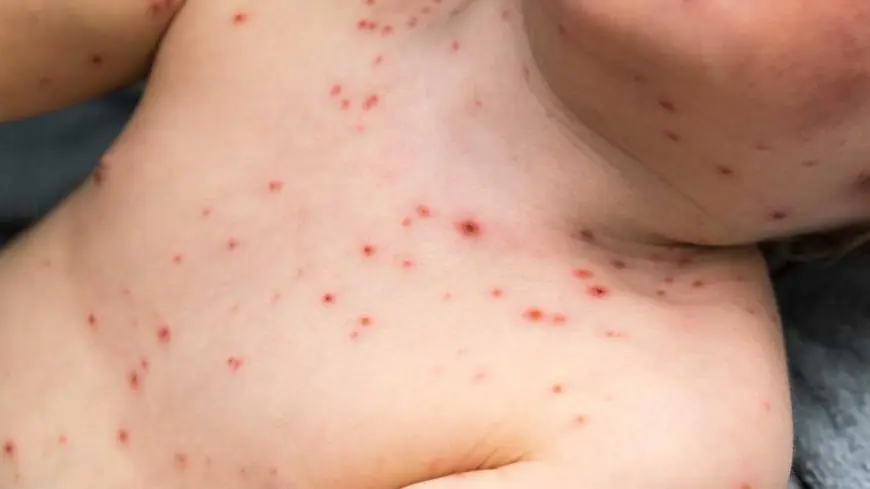 ਏਐਚਐਸ ਨੇ ਦਿੱਤੀ ਕੈਲਗਰੀ ਮੈਡੀਕਲ ਸੈਂਟਰ ਅਤੇ ਬਰੂਅਰੀ ਵਿਖੇ ਖਸਰੇ ਦੇ ਸੰਭਾਵੀ ਸੰਪਰਕ ਦੀ ਚੇਤਾਵਨੀ